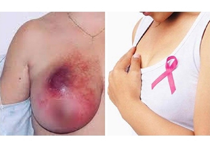 Người bị ung thư vú có thể bị đâu đầu nhũ hoa và nhiều dấu hiệu bất thường khác